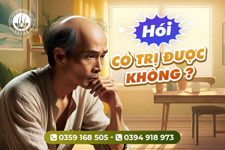 Hói có trị được không? Phương pháp chữa hói hiệu quả dứt điểm